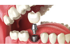 Dental Implants in Geneva