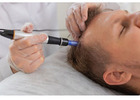 Best Microneedling Clinic in Burleigh Heads